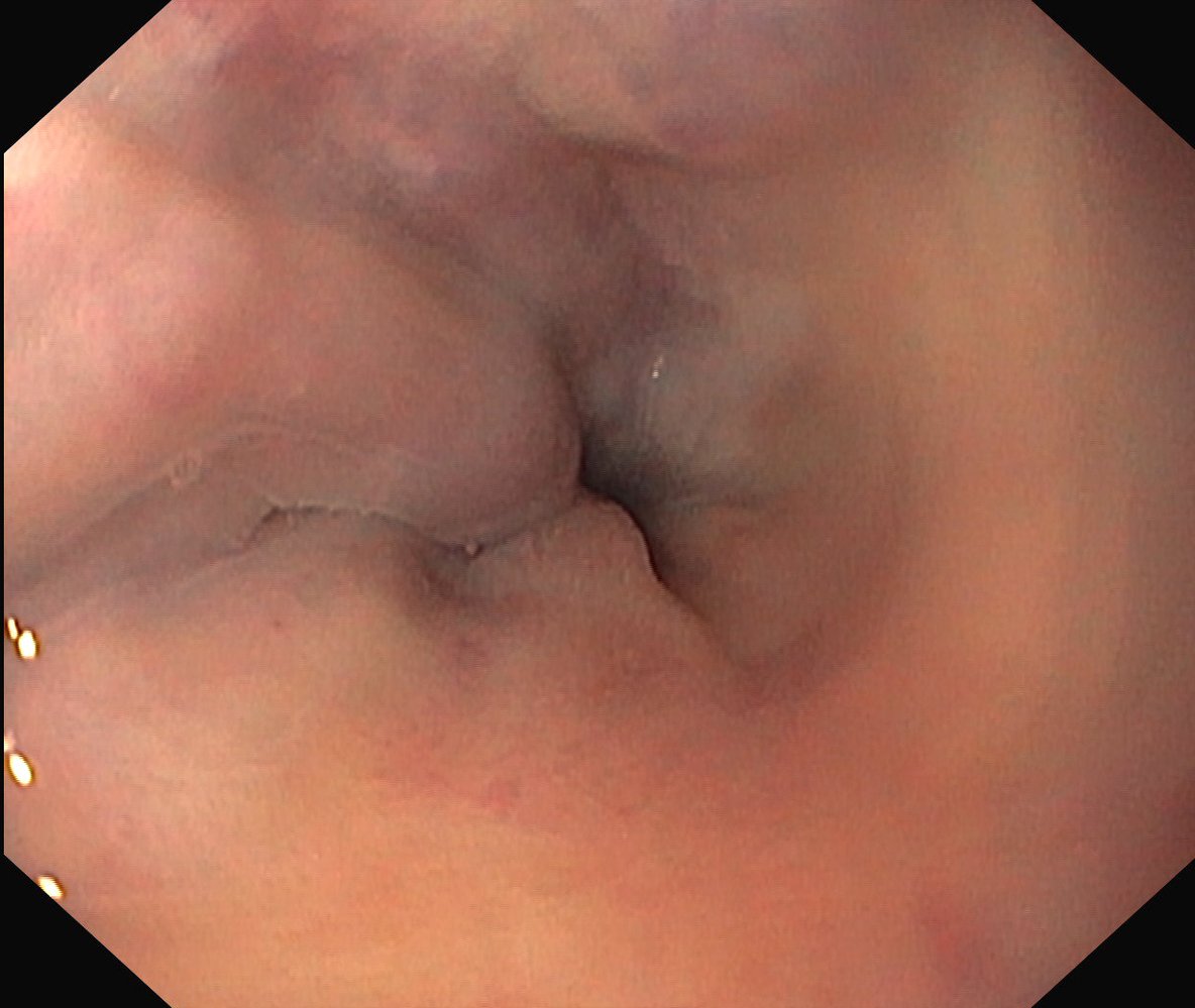 Esophageal varices
