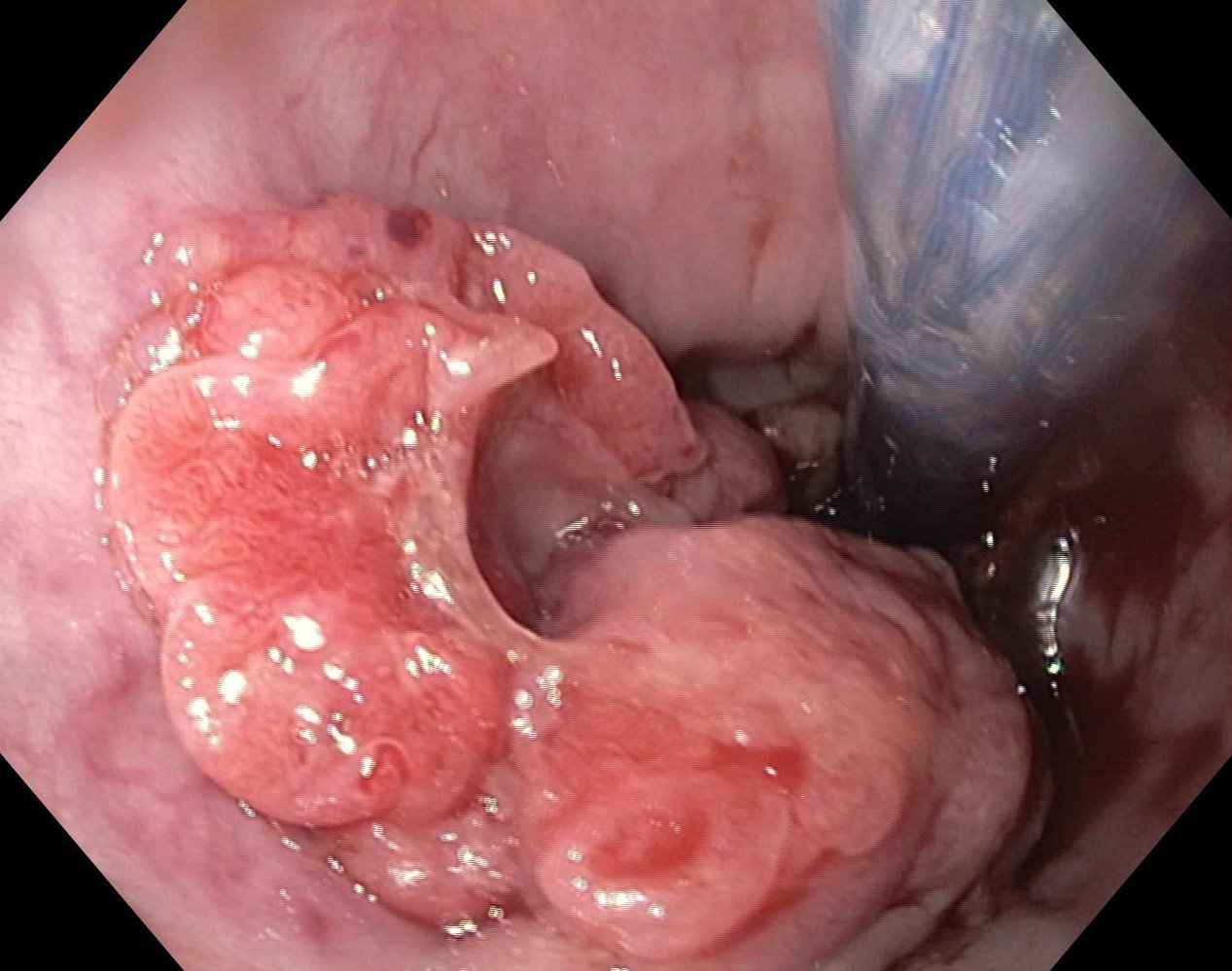 Esophageal carcinoma