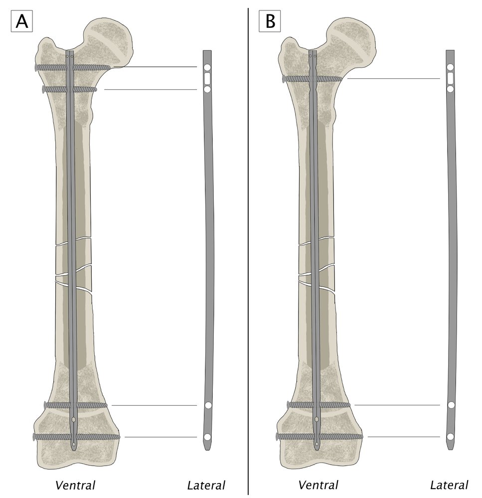 Intramedullary nail fixation of femoral shaft fracture
