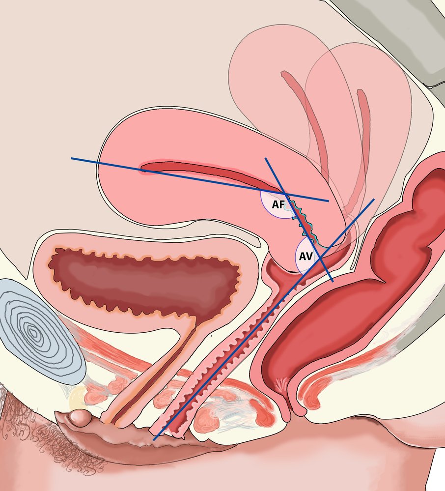 Uterus and its anatomic position in the small pelvis
