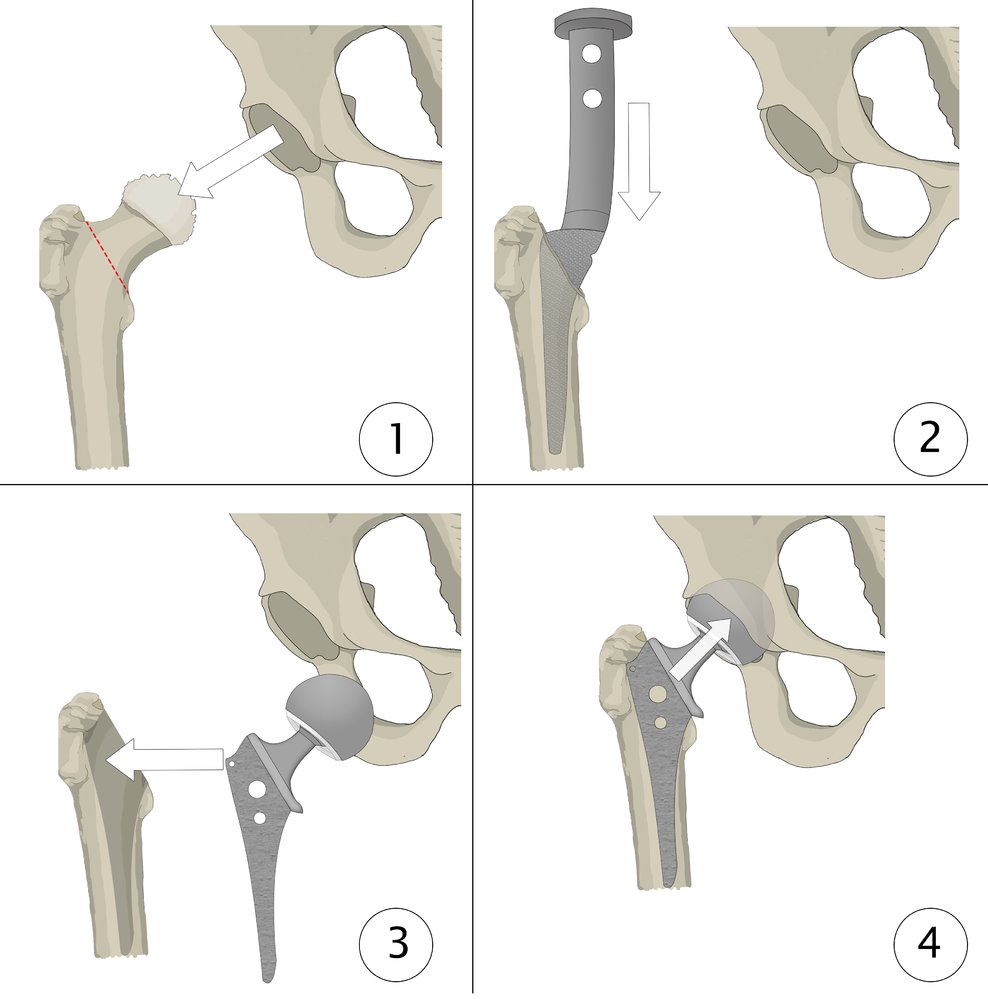 Hip hemiarthroplasty (bipolar prosthesis)