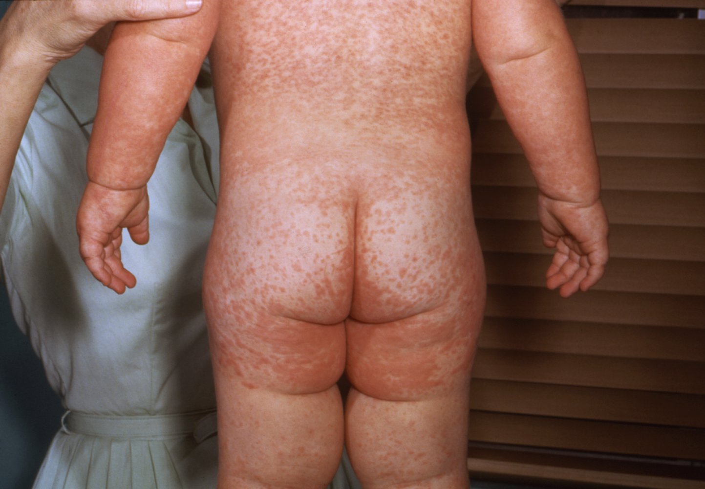 Measles rash