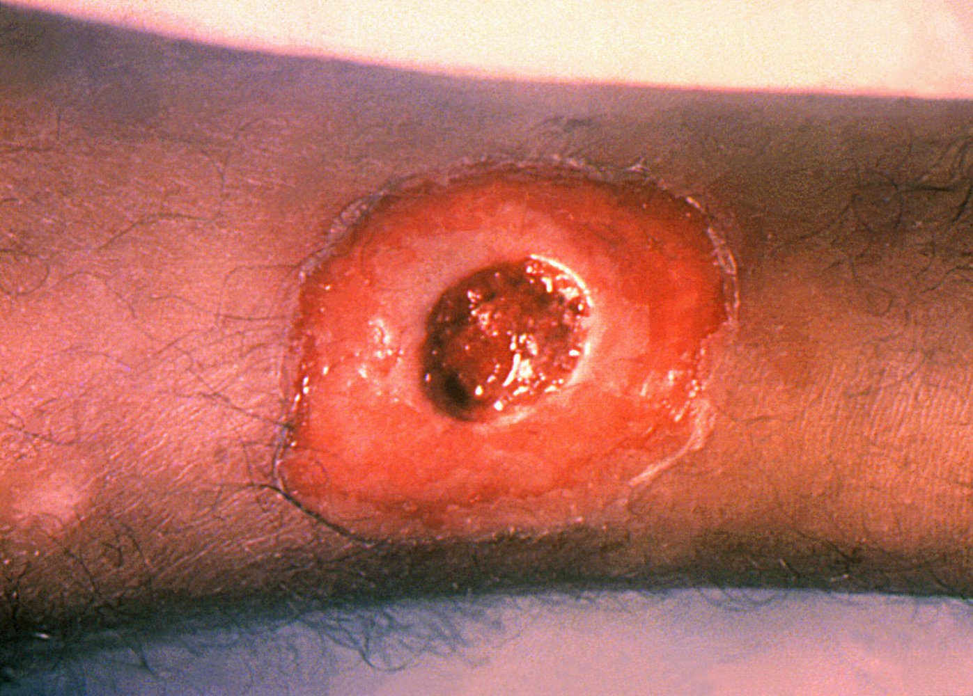 Cutaneous diphtheria