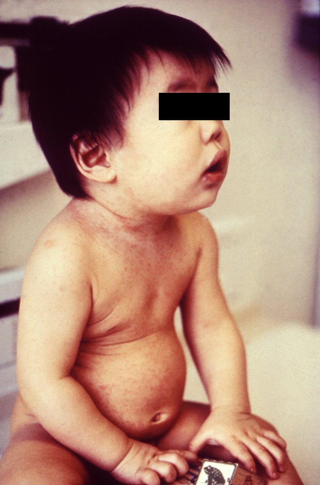 Rubella rash