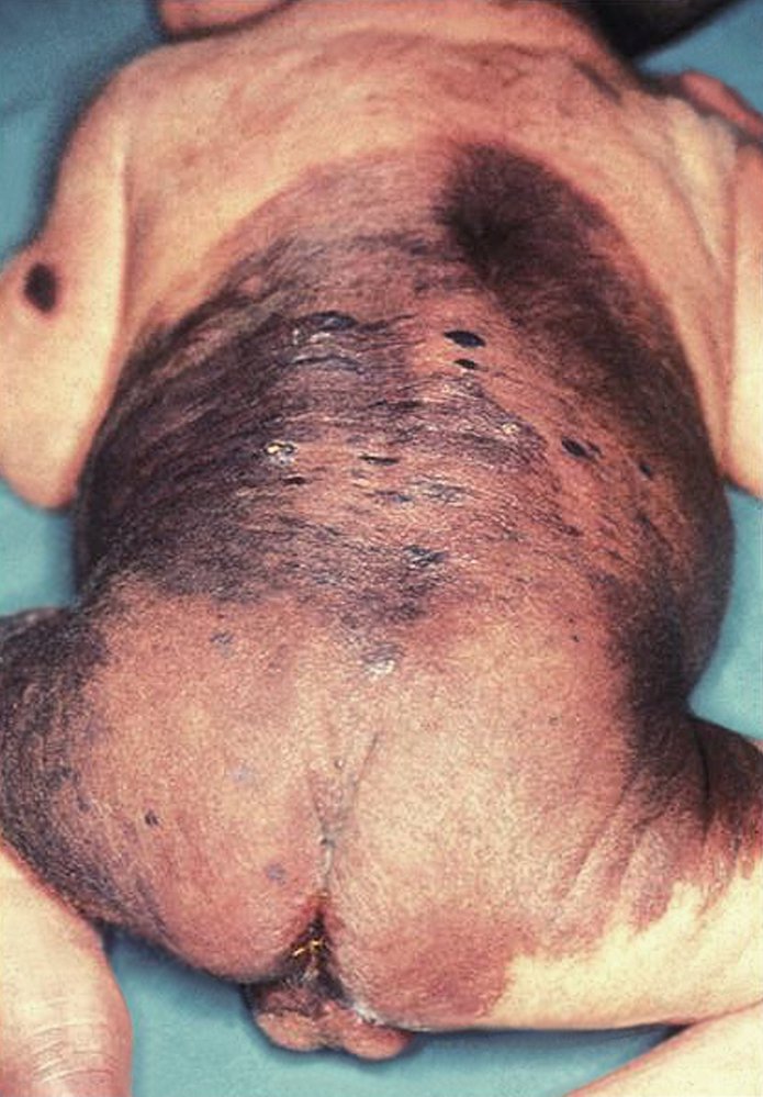 Congenital melanocytic nevi