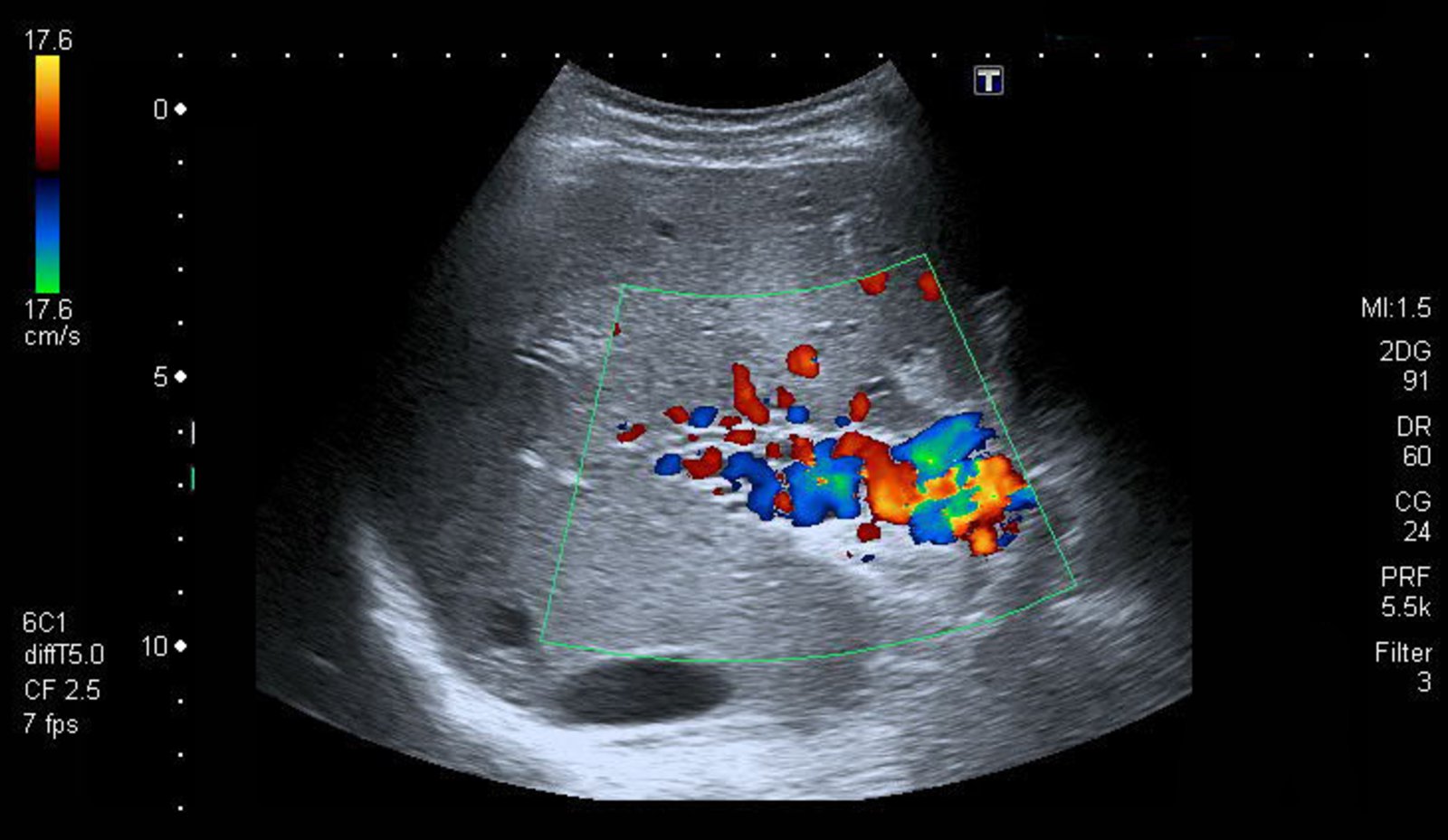Cavernous transformation of the portal vein