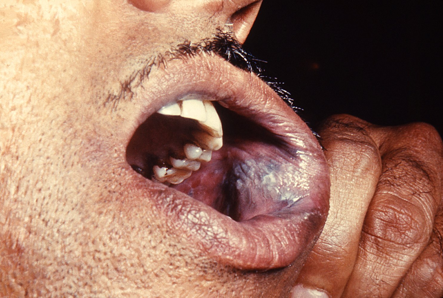 Pemphigus vulgaris