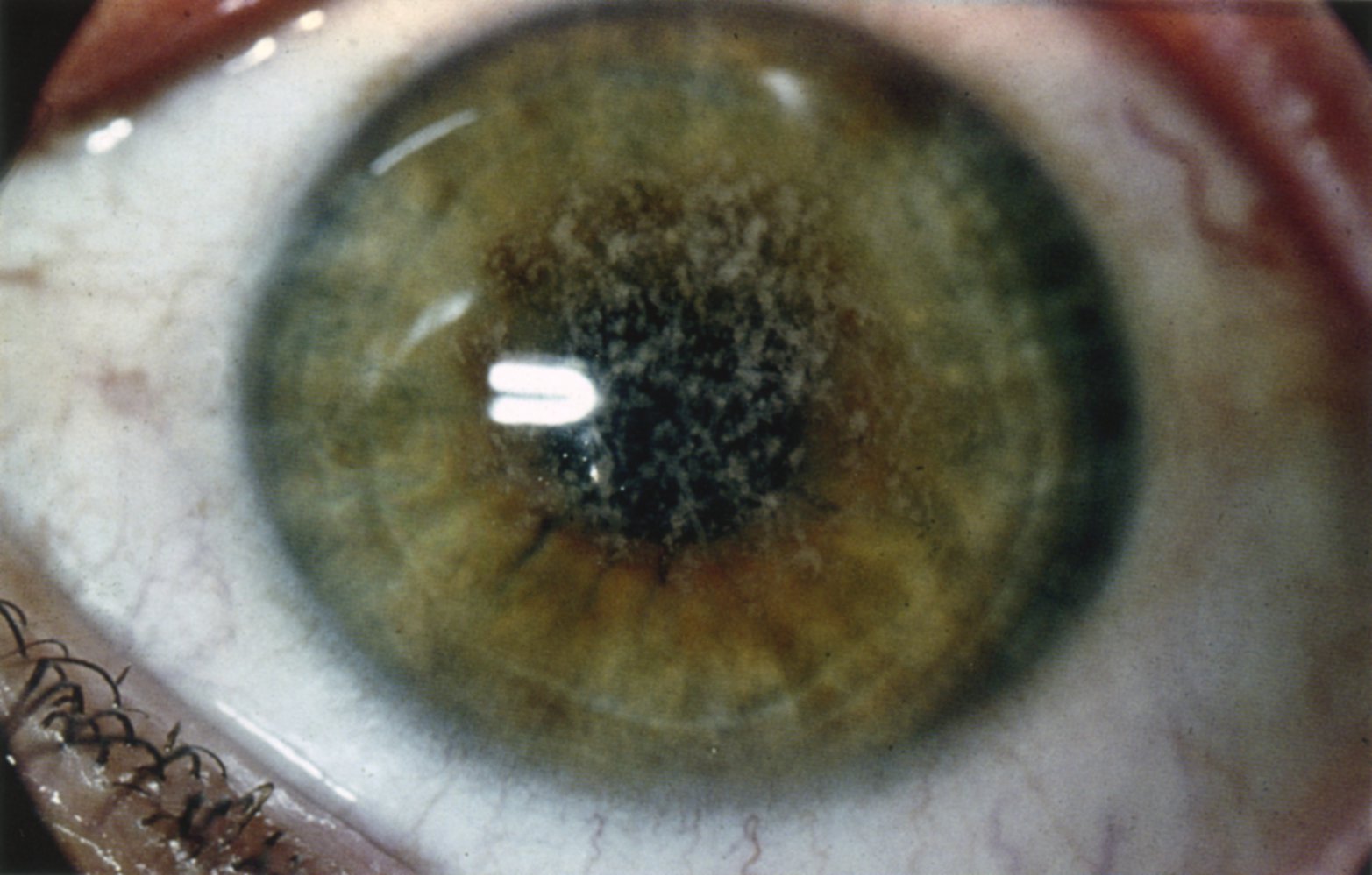 Granular corneal dystrophy 1/2