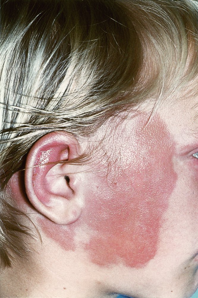 Facial erysipelas