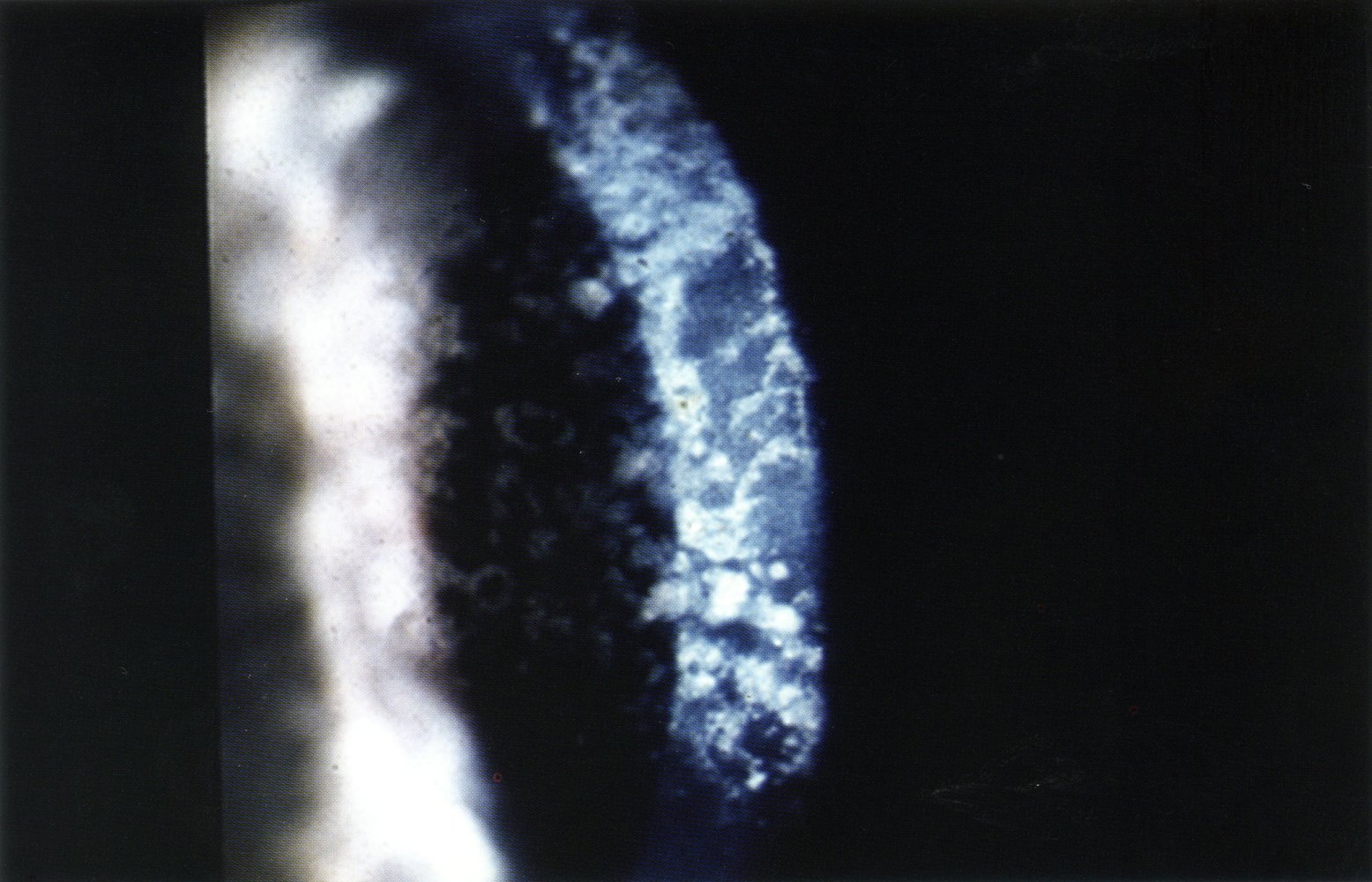 Granular corneal dystrophy 2/2