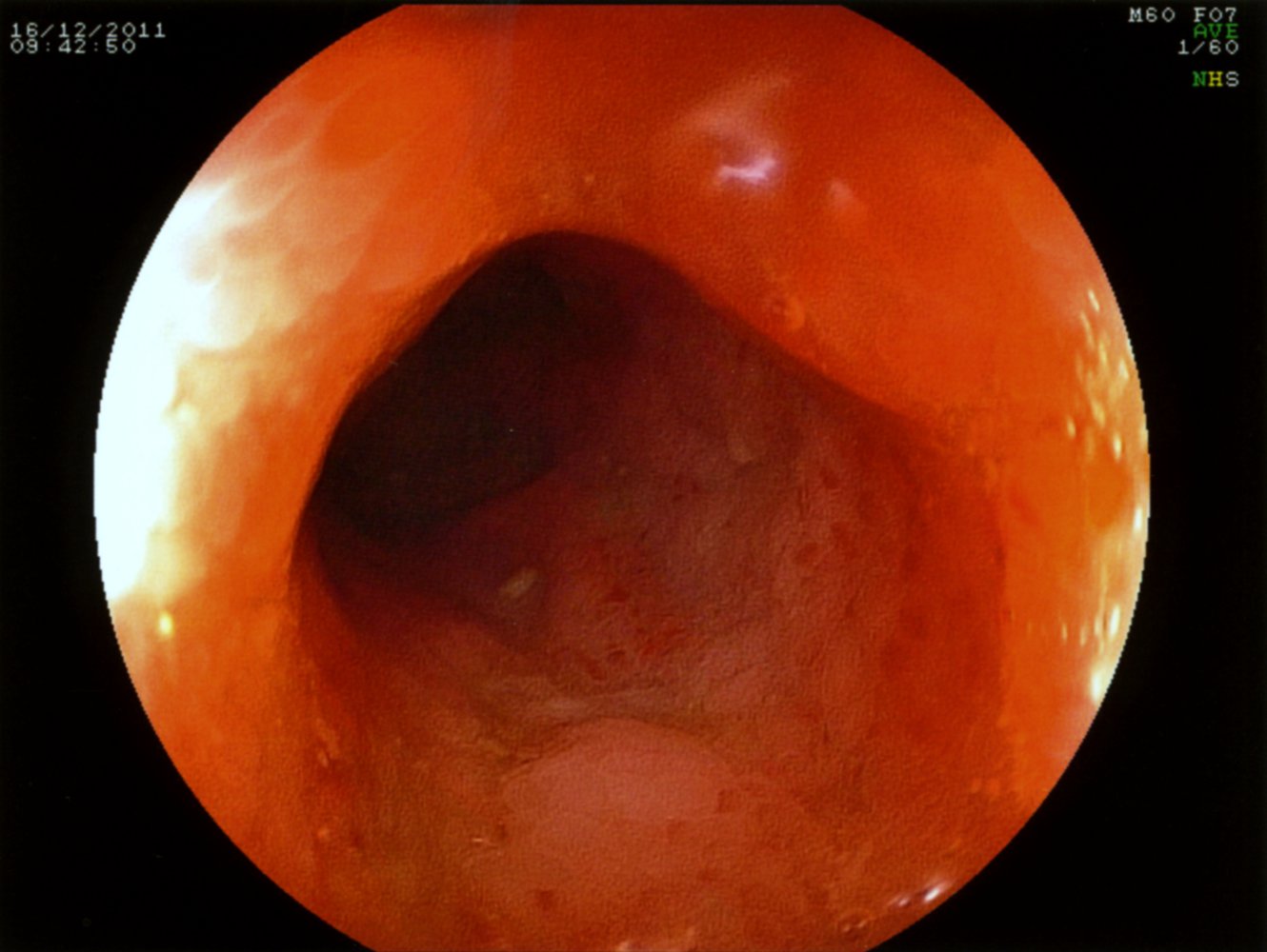 Terminal ileum in Crohn disease