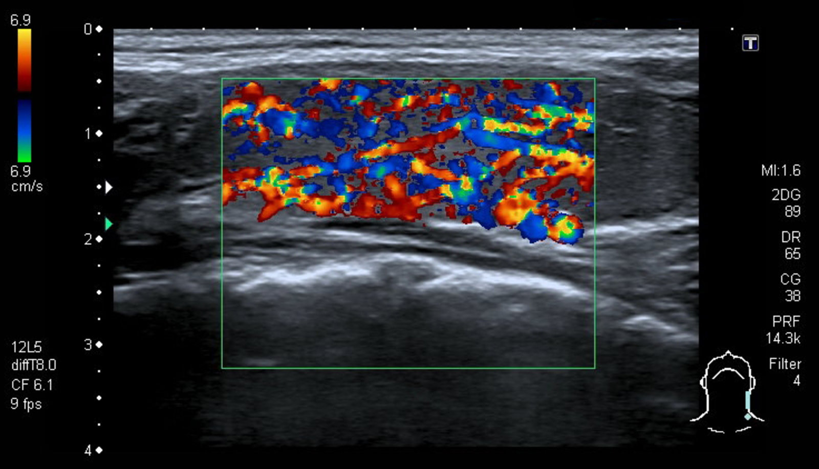 Hypervascular thyroid gland