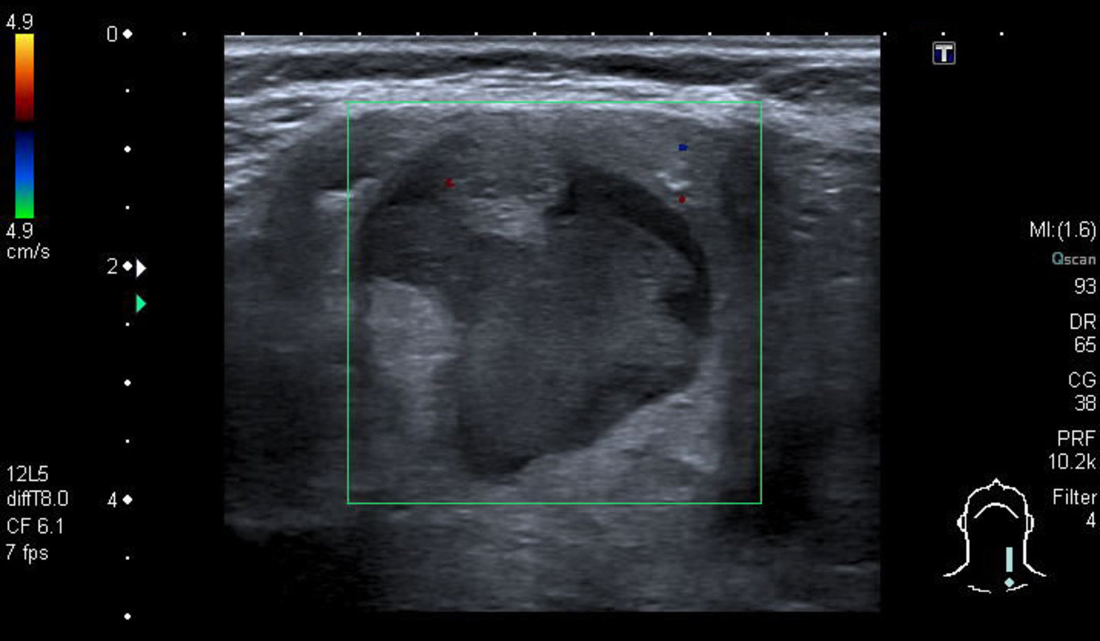 Mixed echogenicity thyroid nodule