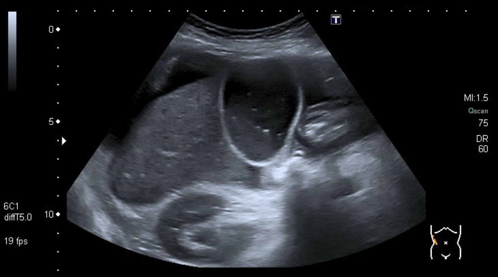 Gallbladder mucocele