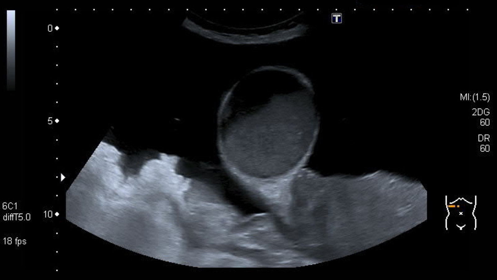 Gallbladder mucocele