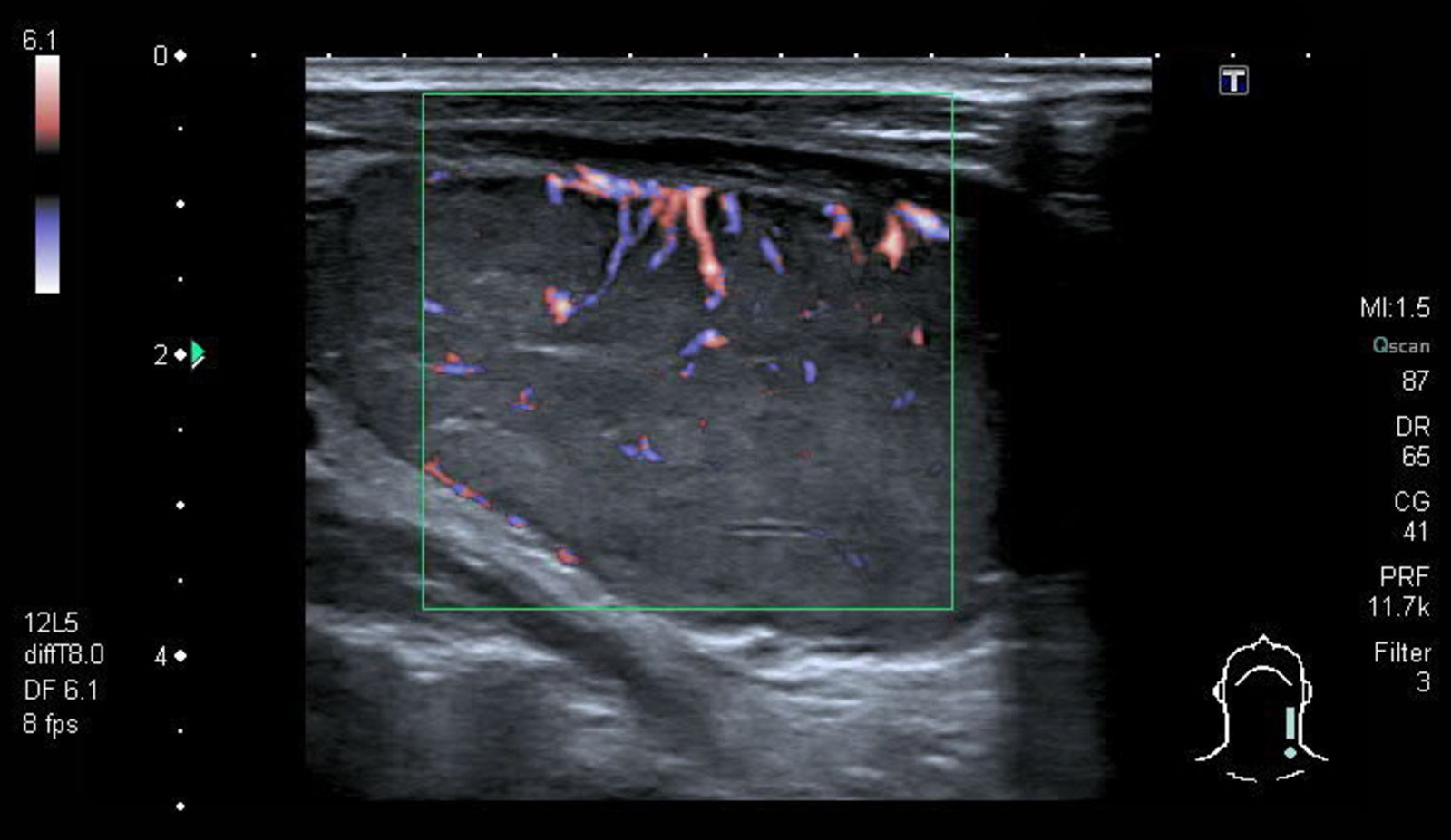 Solid thyroid nodule