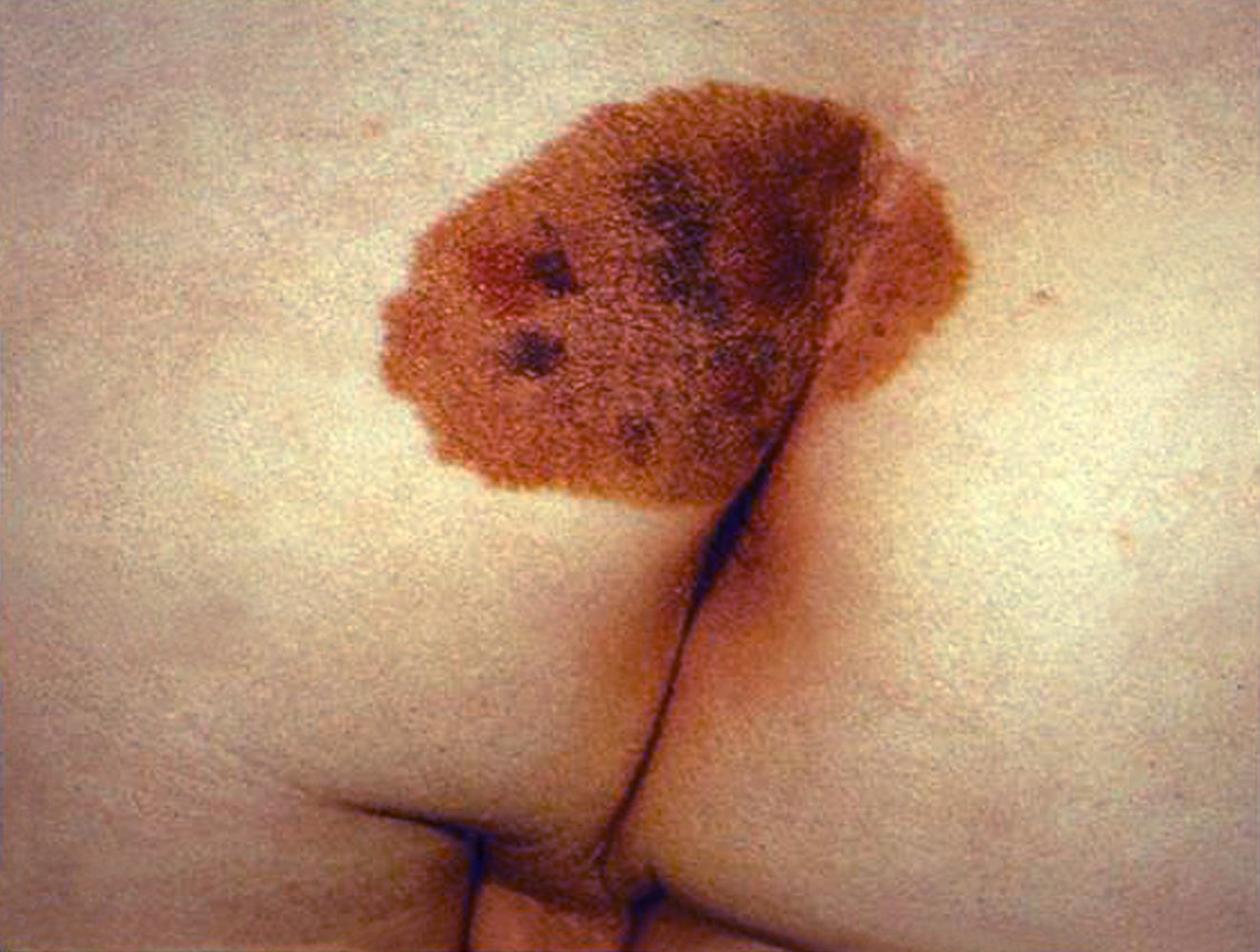 Congenital nevus in the intergluteal region