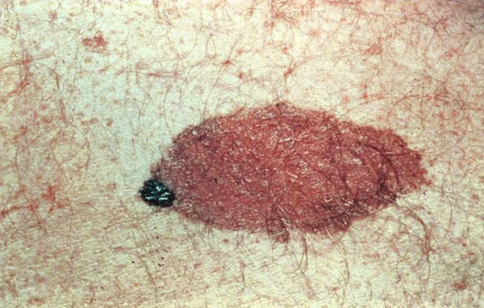 Congenital nevus