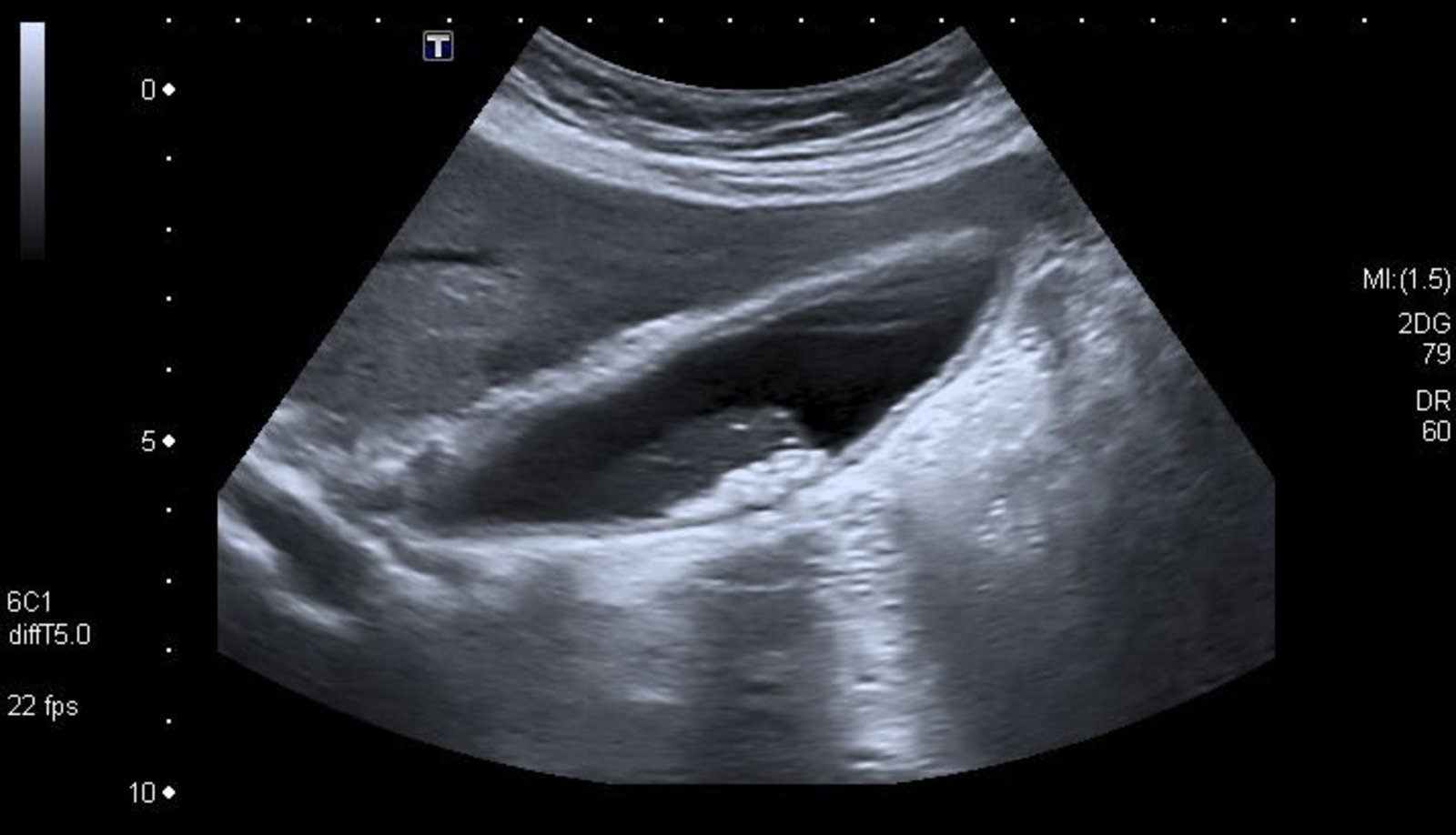 Gallbladder calculi and wall thickening