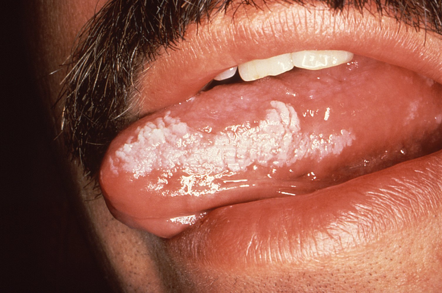 HIV patient with oral hairy leukoplakia