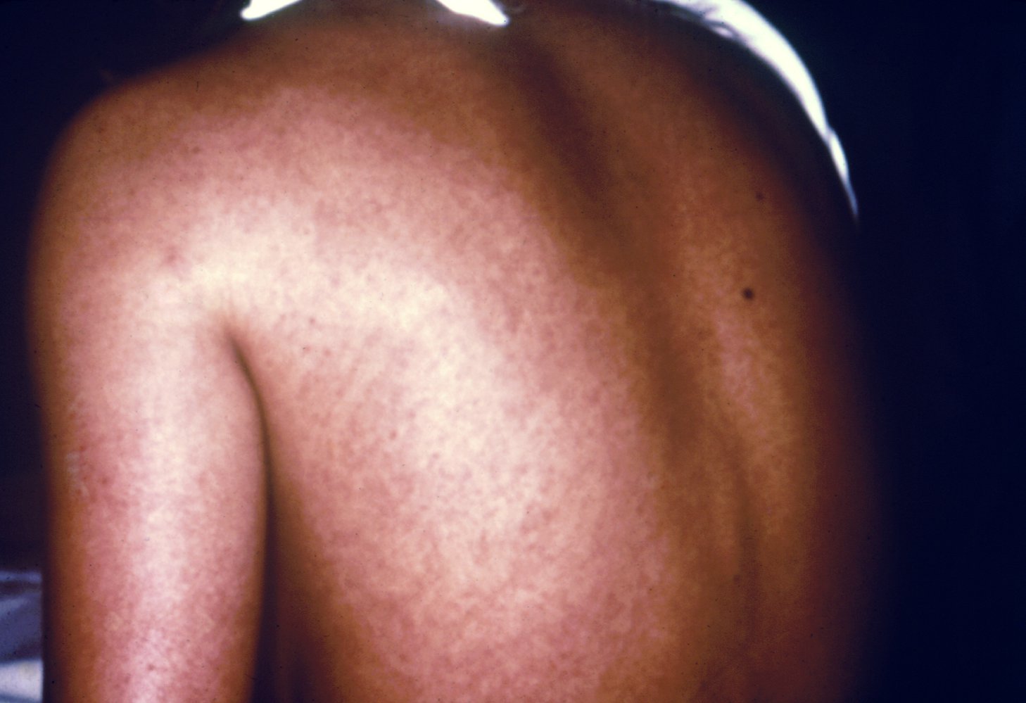 Rash in Marburg virus disease