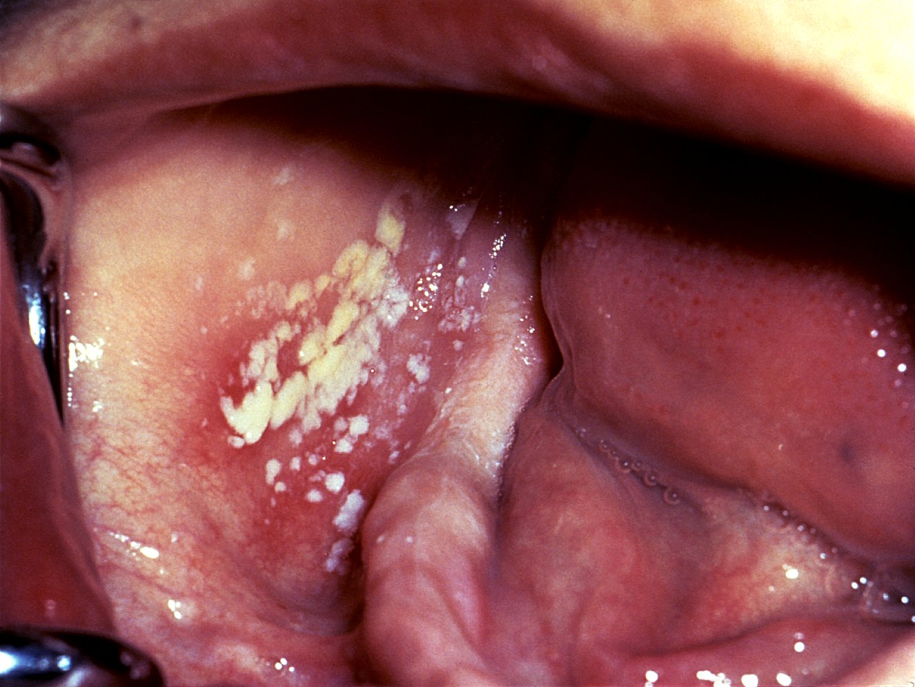 Oral candidiasis