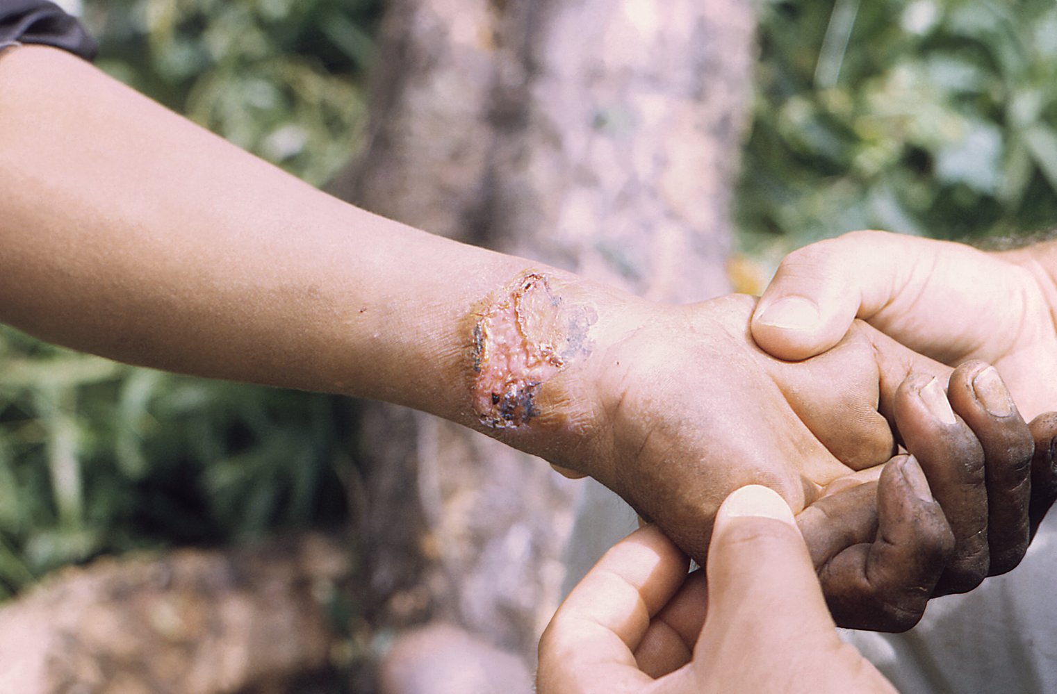 Cutaneous leishmaniasis