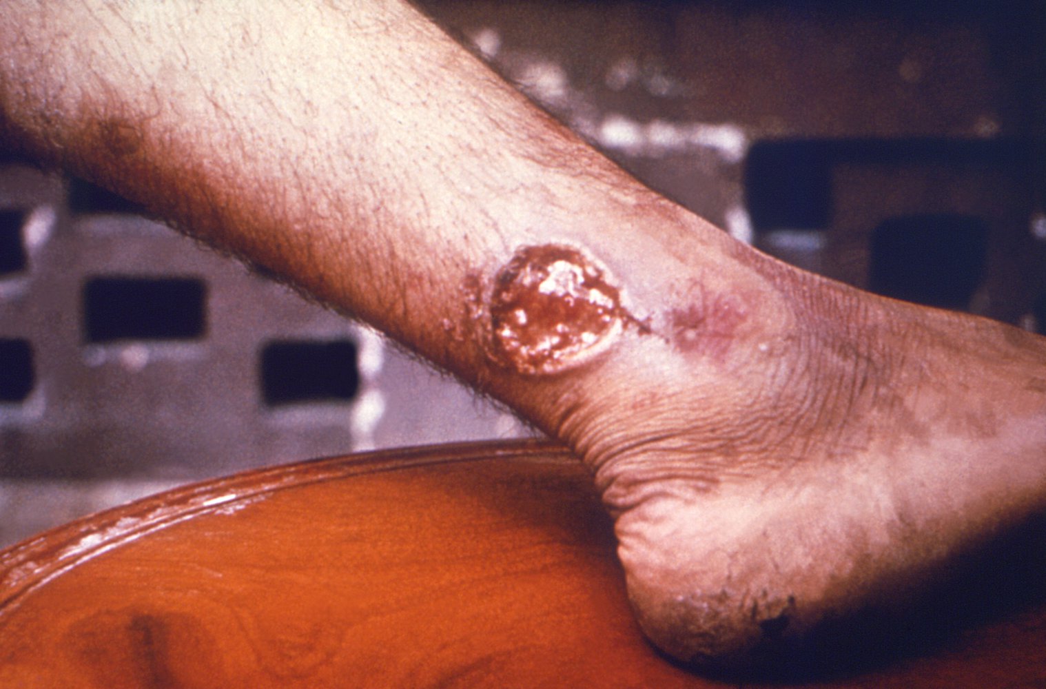 Cutaneous leishmaniasis