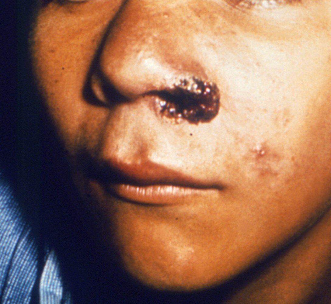 Mucosal leishmaniasis
