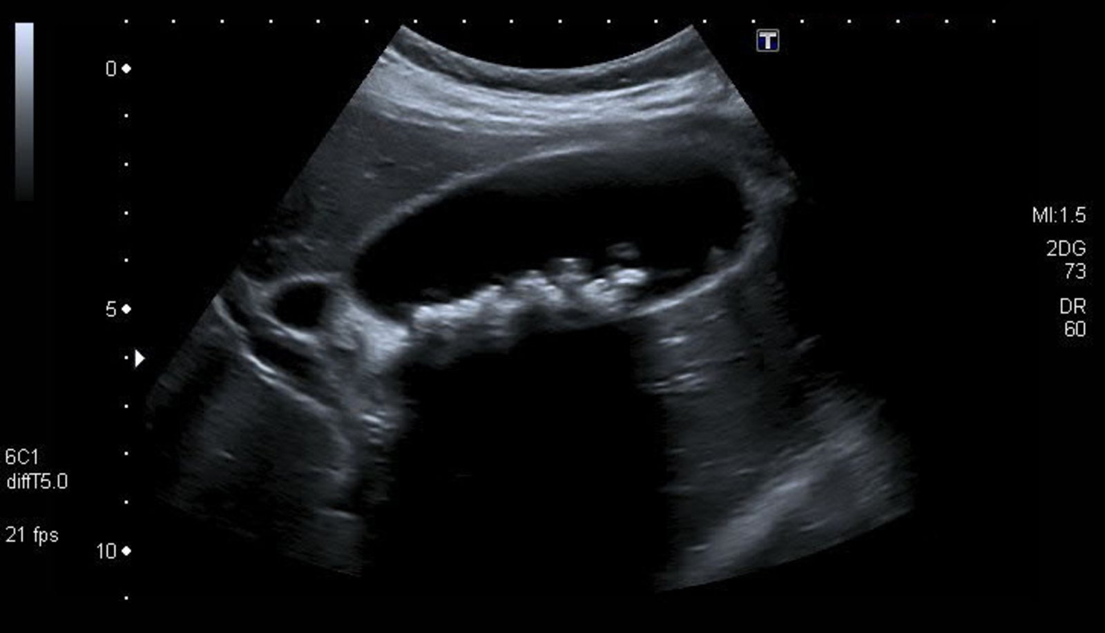 Cholelithiasis