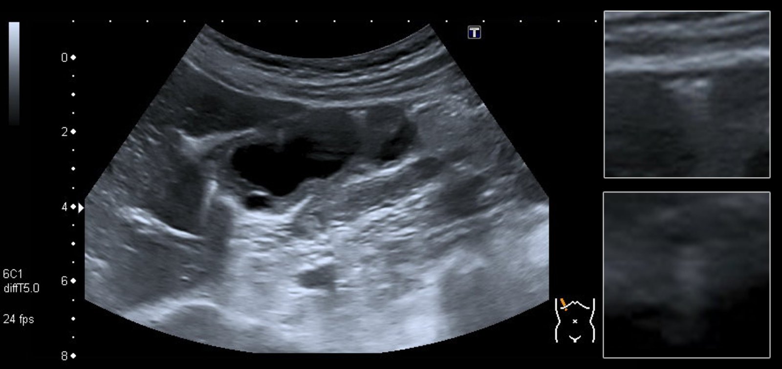 Emphysematous cholecystitis