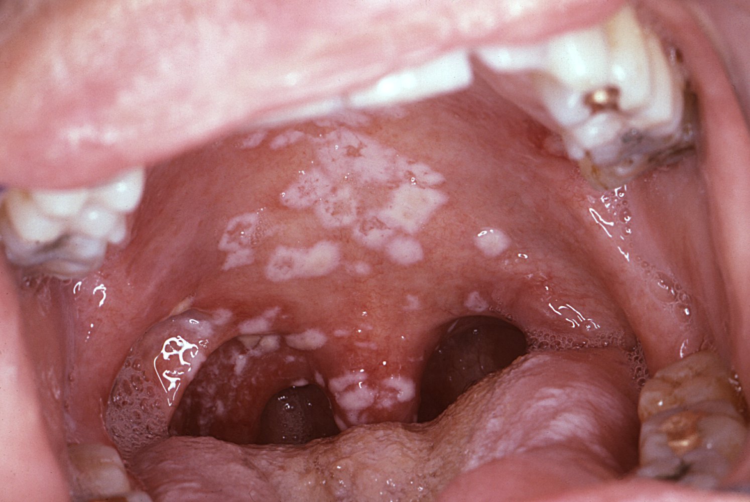 Oral candidiasis