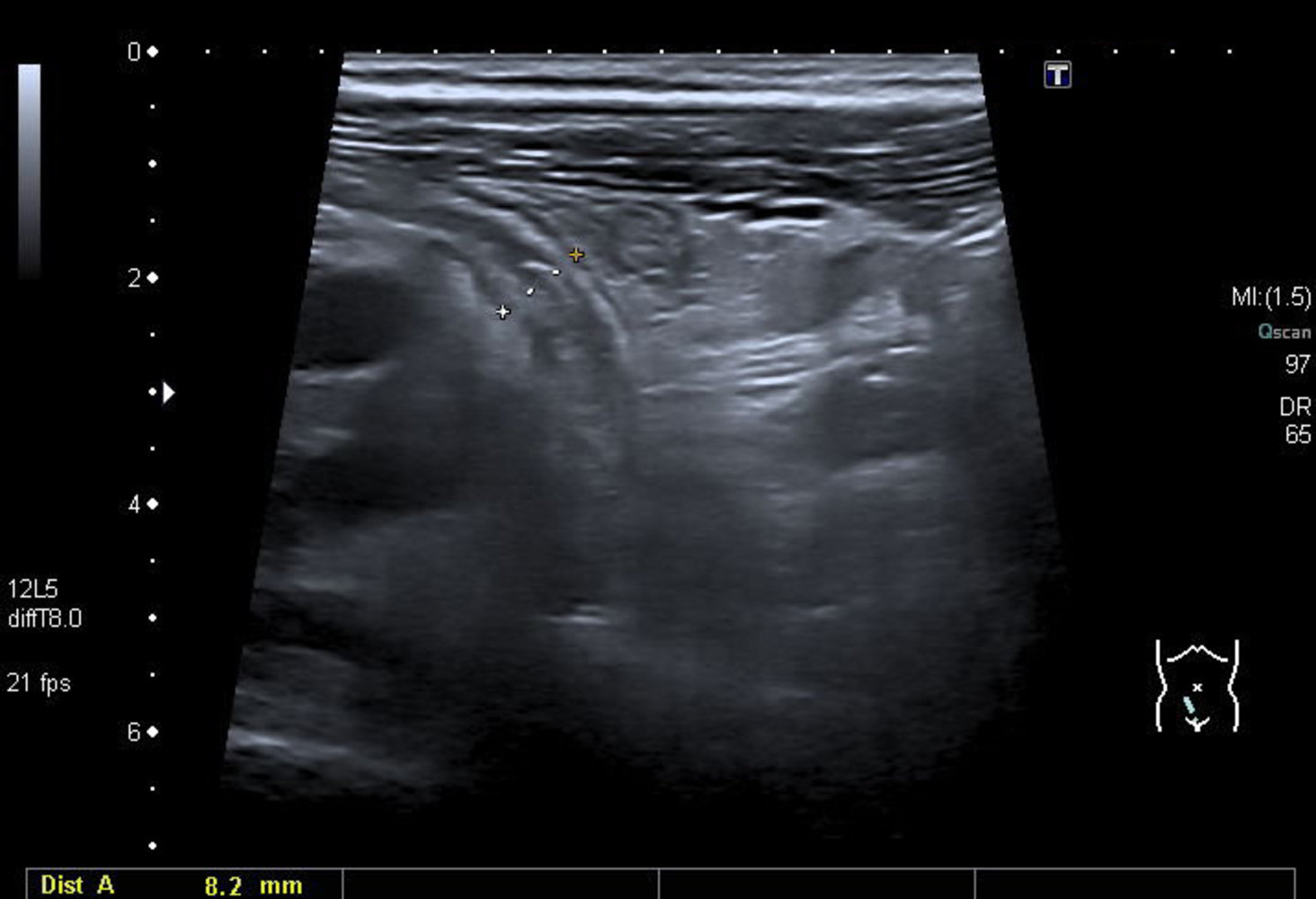 Acute appendicitis