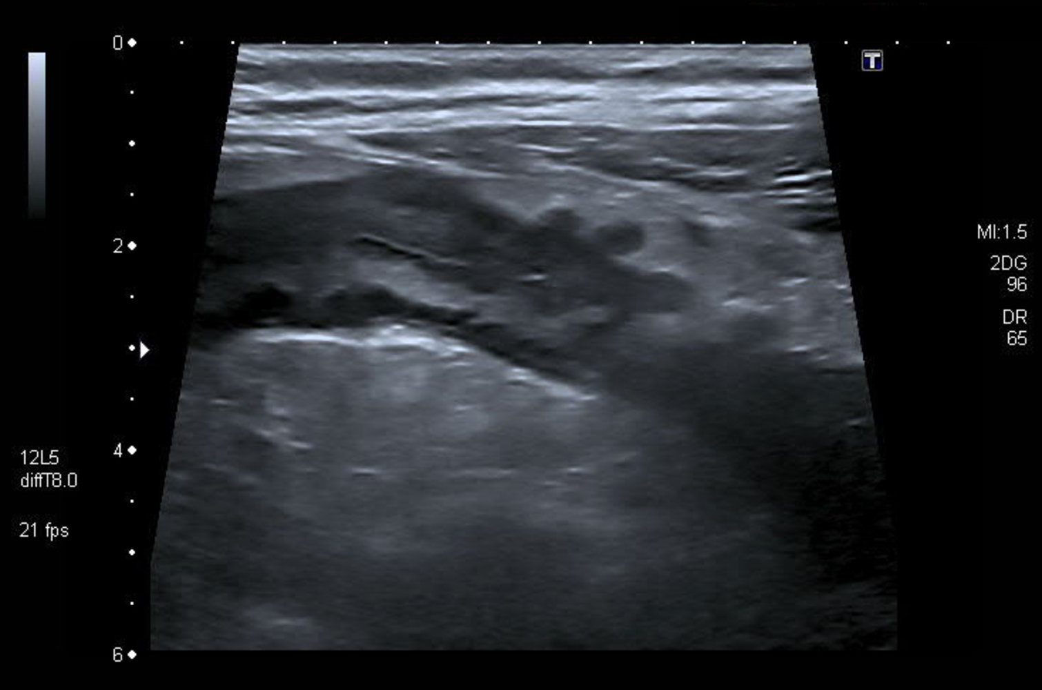 Diverticulitis