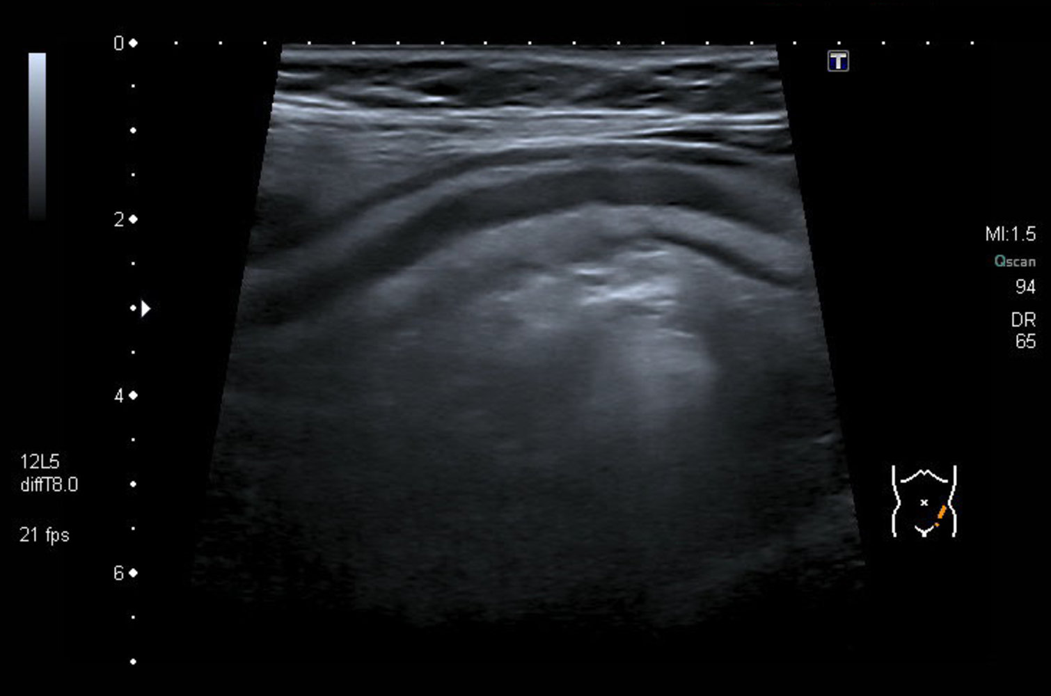 Ulcerative colitis