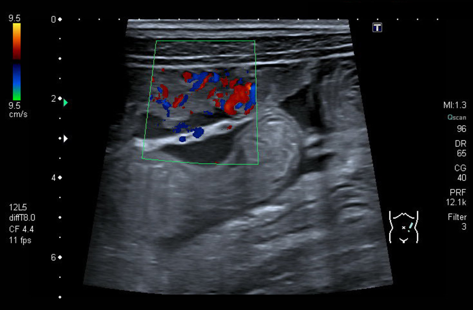 Peritoneal carcinomatosis