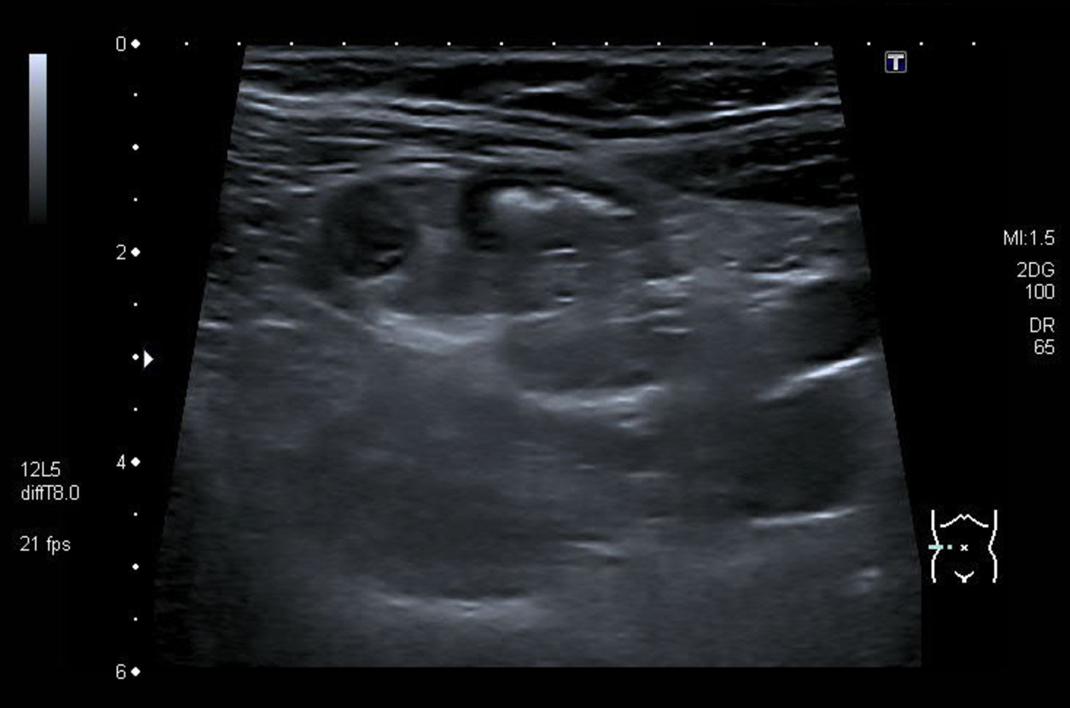 Appendicitis with target sign