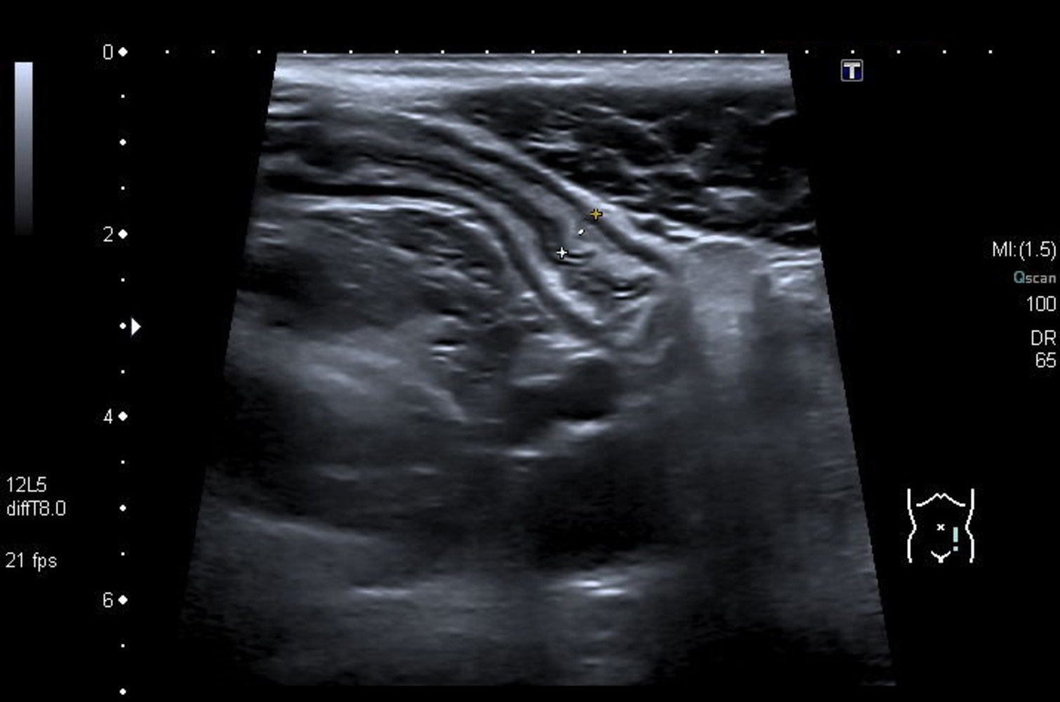 Ulcerative colitis
