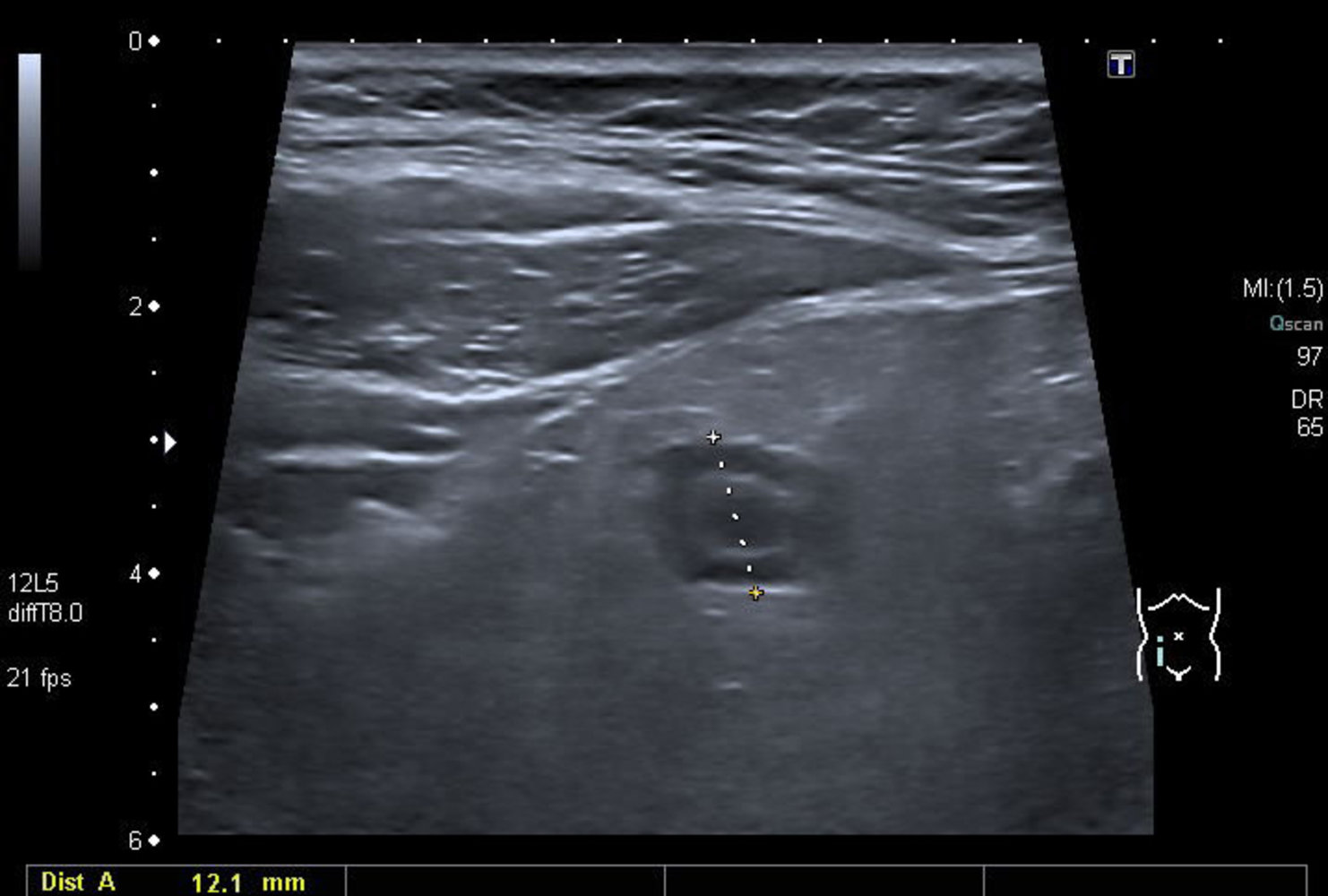 Appendicitis with target sign