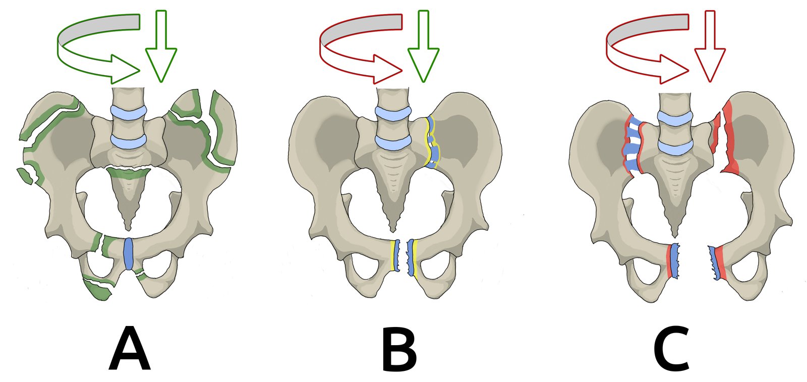 Pelvic ring fracture: Tile classification