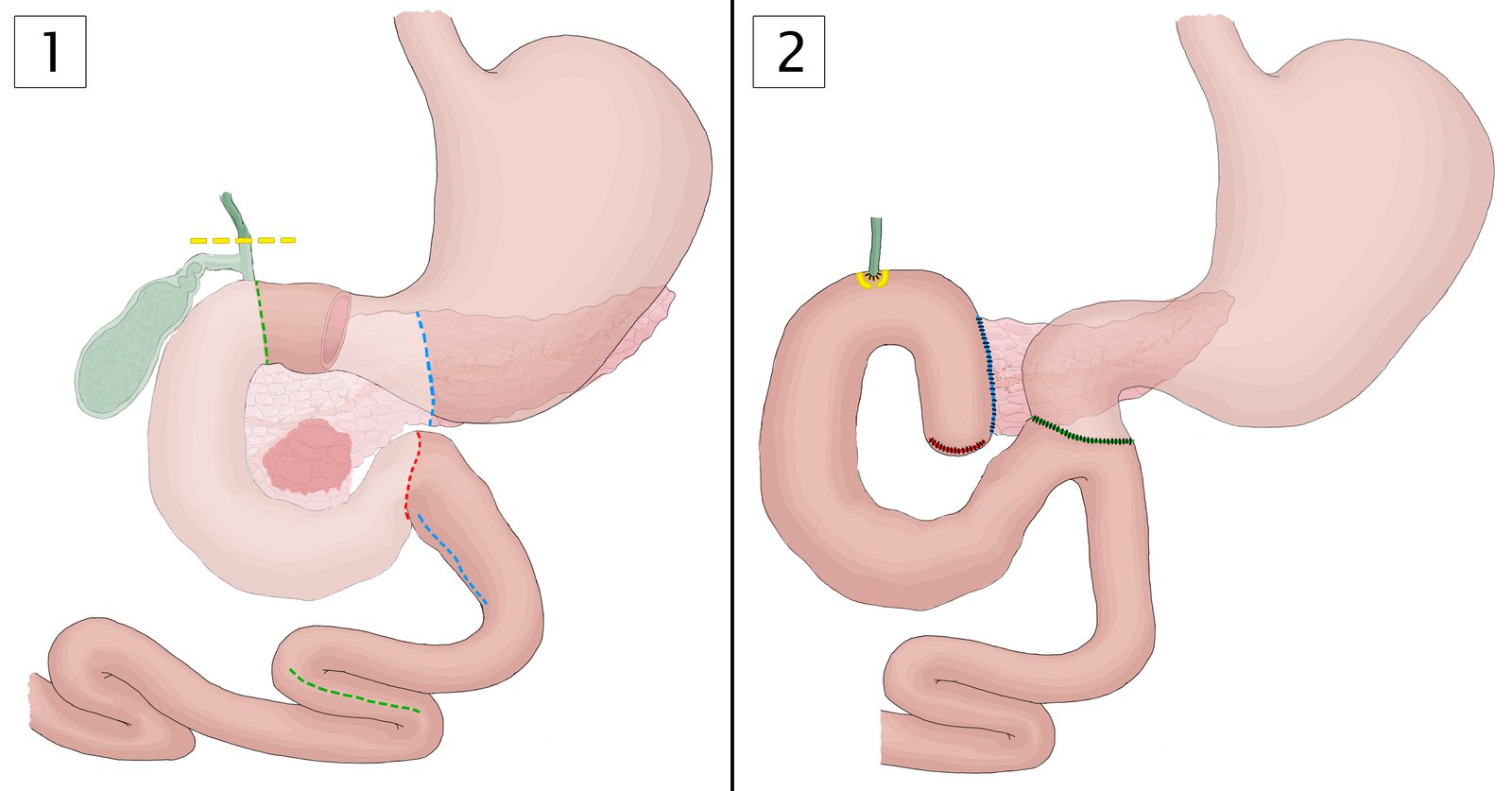 Principles of the pylorus-preserving pancreaticoduodenectomy (Traverso-Longmire procedure)