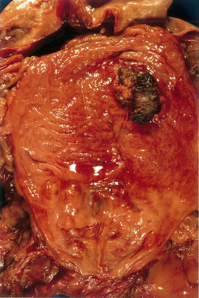 Urothelial cancer