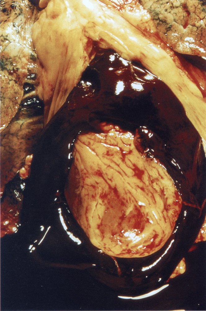 Pericardial tamponade: opened pericardium (2/2)