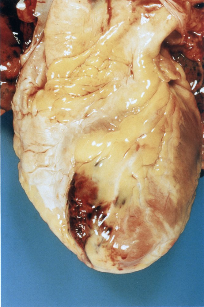 Pericardial tamponade: closed pericardium (1/2)