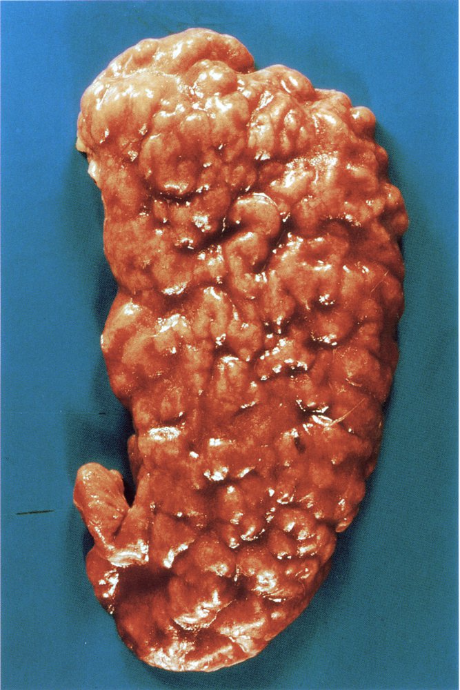 Chronic pyelonephritis kidney specimen
