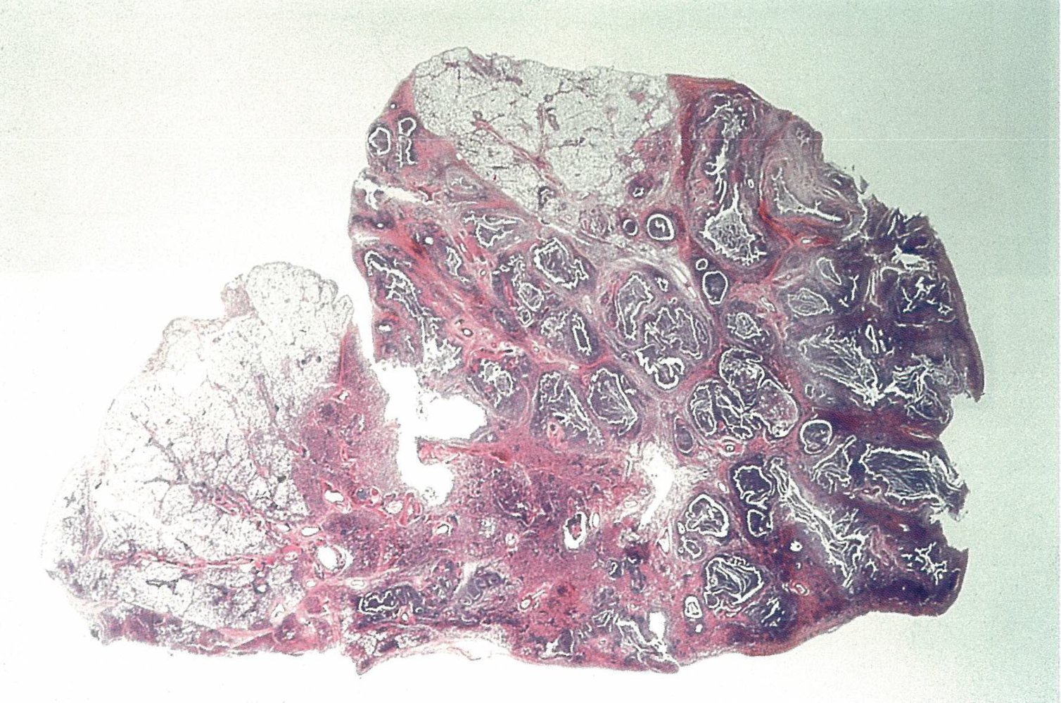 Pulmonary tuberculosis