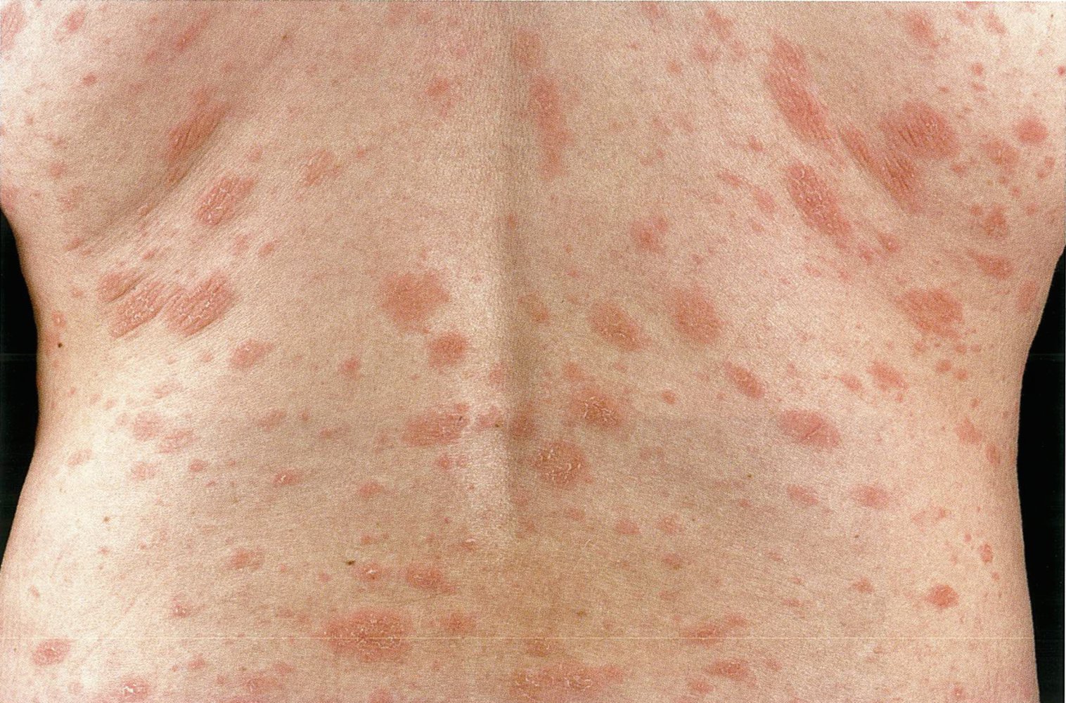 Pityriasis rosea