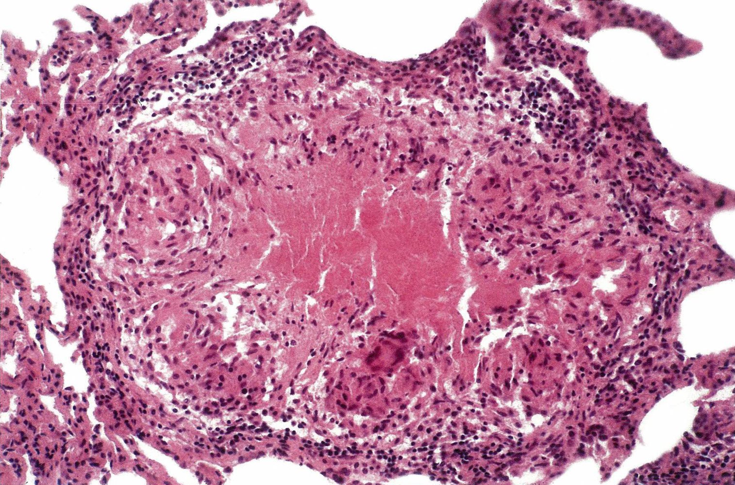 Miliary tuberculosis