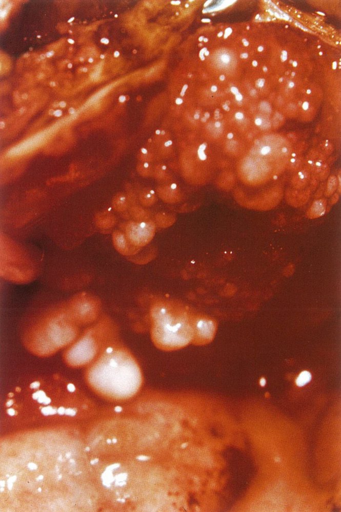 Sarcoma botryoides