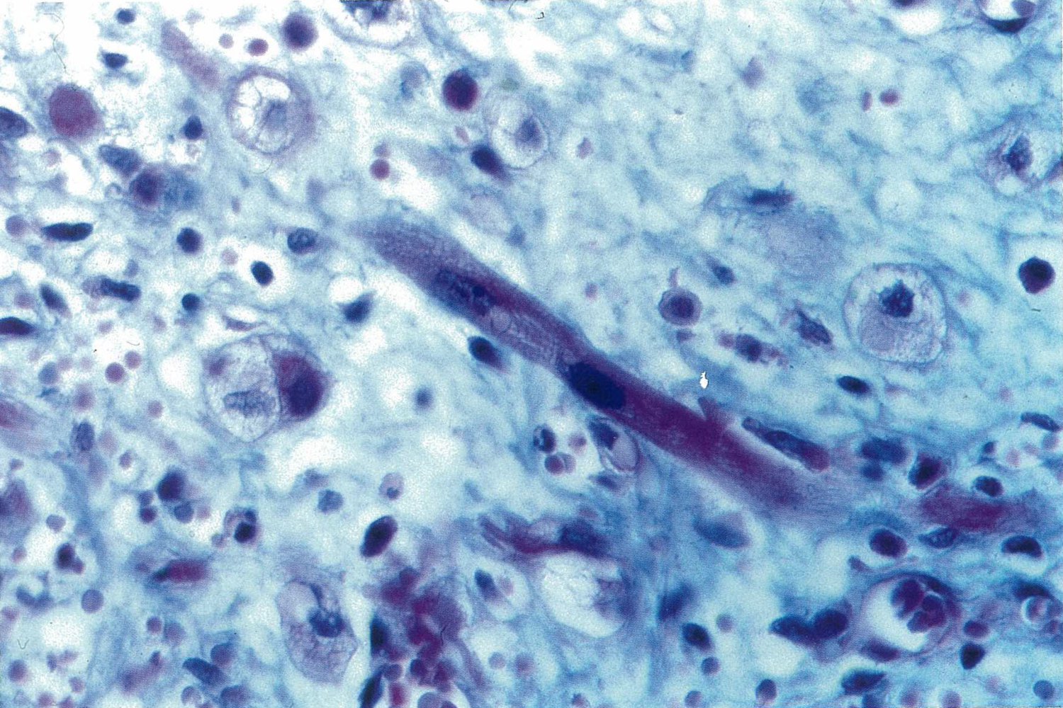 Sarcoma botryoides